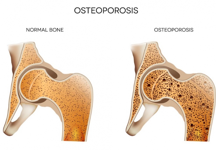 Οστεοπόρωση: Η σιωπηλή απειλή για τα οστά μας